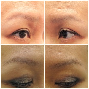 Eyebrow PRP therapy